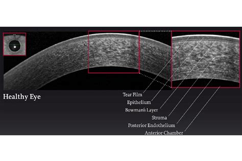 instrument measures thickness of cornea p|thickness of the cornea.